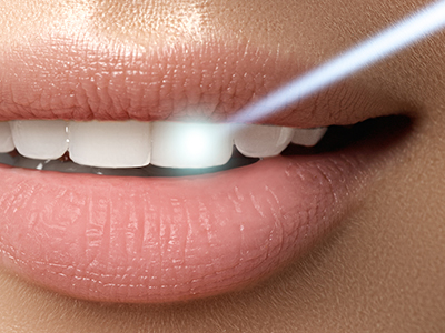 Ahwatukee Dentistry, PLLC | All-on-6, Inlays  amp  Onlays and Full Mouth Rejuvenation